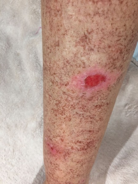 danger epilateur lumiere pulsee